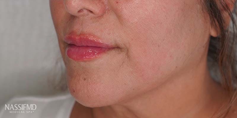 Fillers Before & After Gallery - Patient 121378555 - Image 2
