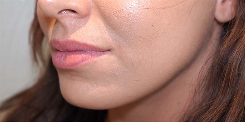 Fillers Before & After Gallery - Patient 121378564 - Image 1
