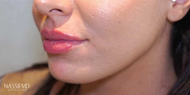 Fillers Before & After Gallery - Patient 121378564 - Image 2