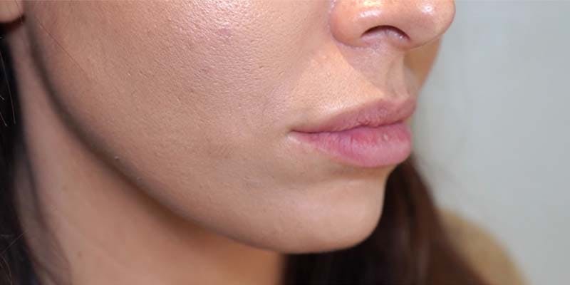 Fillers Before & After Gallery - Patient 121378865 - Image 1