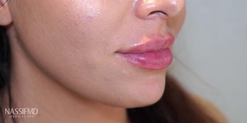 Fillers Before & After Gallery - Patient 121378865 - Image 2