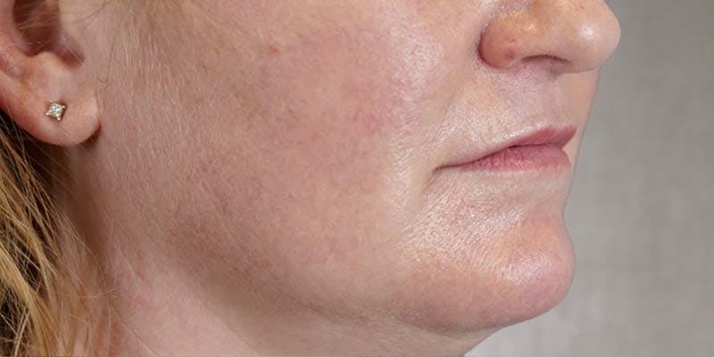Fillers Before & After Gallery - Patient 121378863 - Image 1