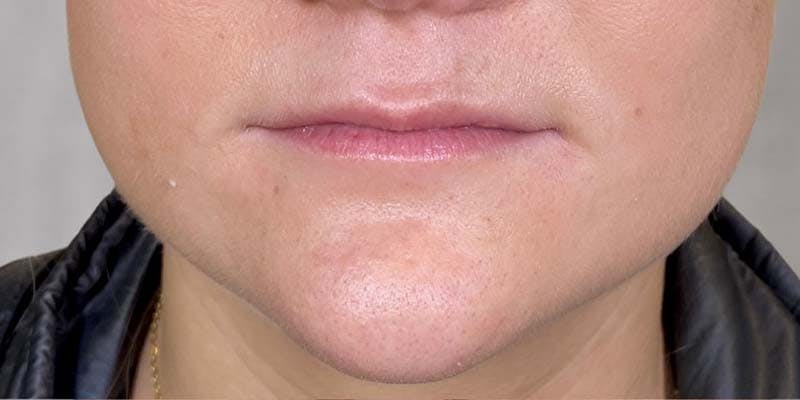 Fillers Before & After Gallery - Patient 121378854 - Image 1