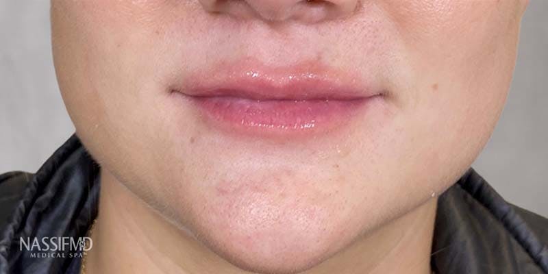 Fillers Before & After Gallery - Patient 121378854 - Image 2
