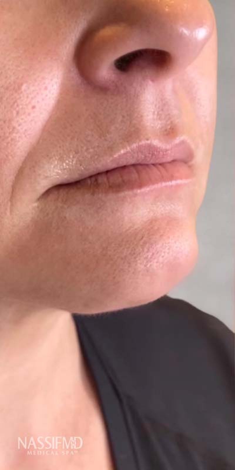 Fillers Before & After Gallery - Patient 121378864 - Image 1
