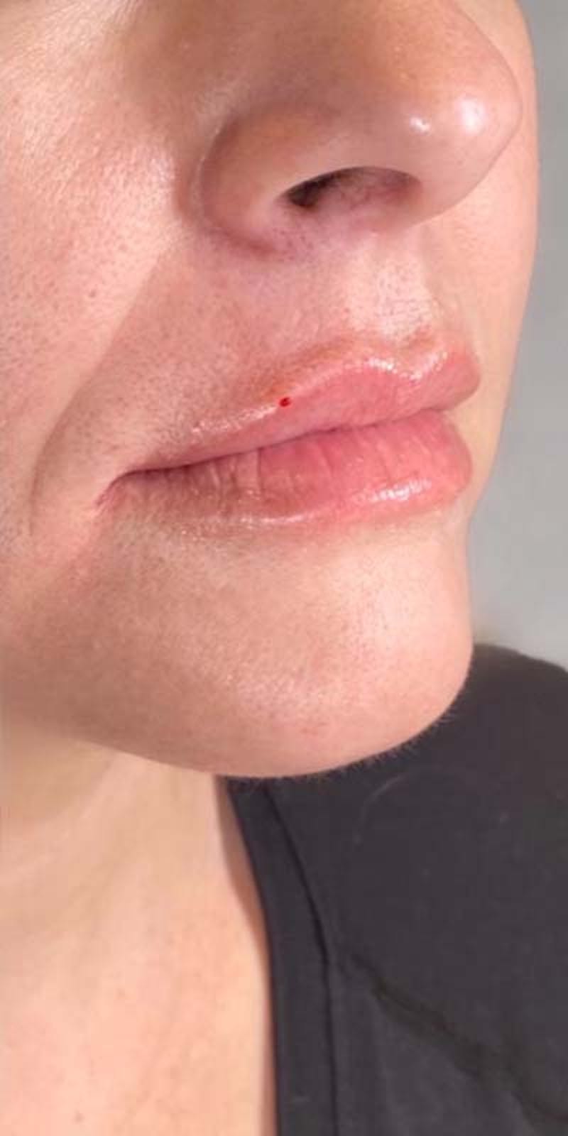 Fillers Before & After Gallery - Patient 121378864 - Image 2