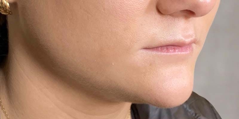 Fillers Before & After Gallery - Patient 121378862 - Image 1