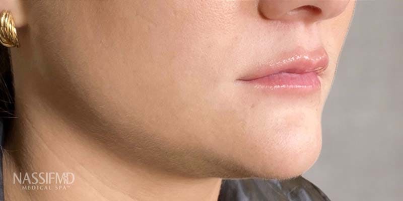 Fillers Before & After Gallery - Patient 121378862 - Image 2