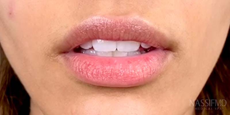 Fillers Before & After Gallery - Patient 121378859 - Image 1
