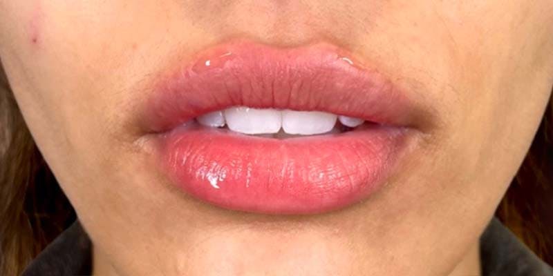 Fillers Before & After Gallery - Patient 121378859 - Image 2