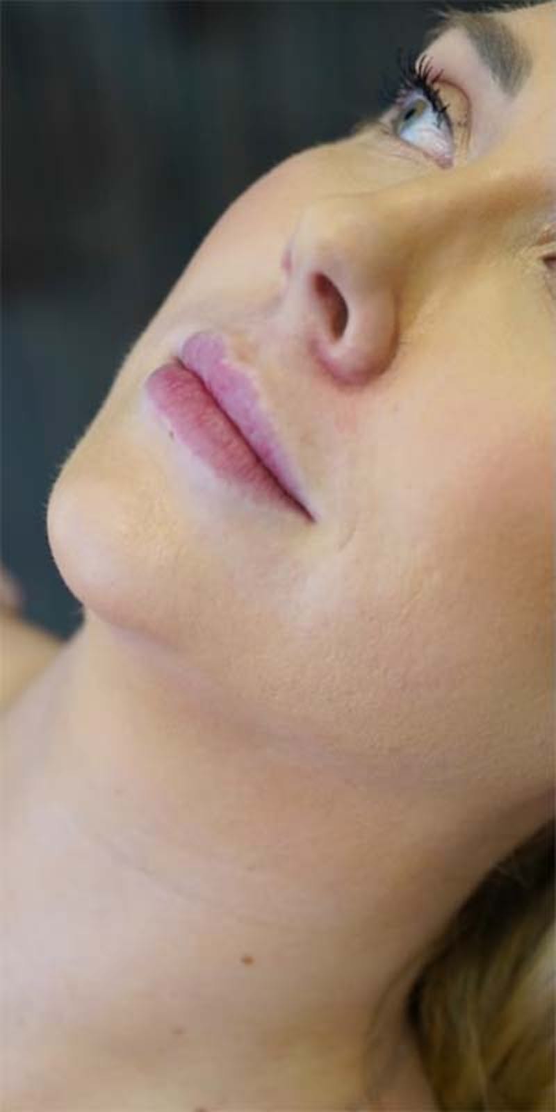 Fillers Before & After Gallery - Patient 121378856 - Image 1