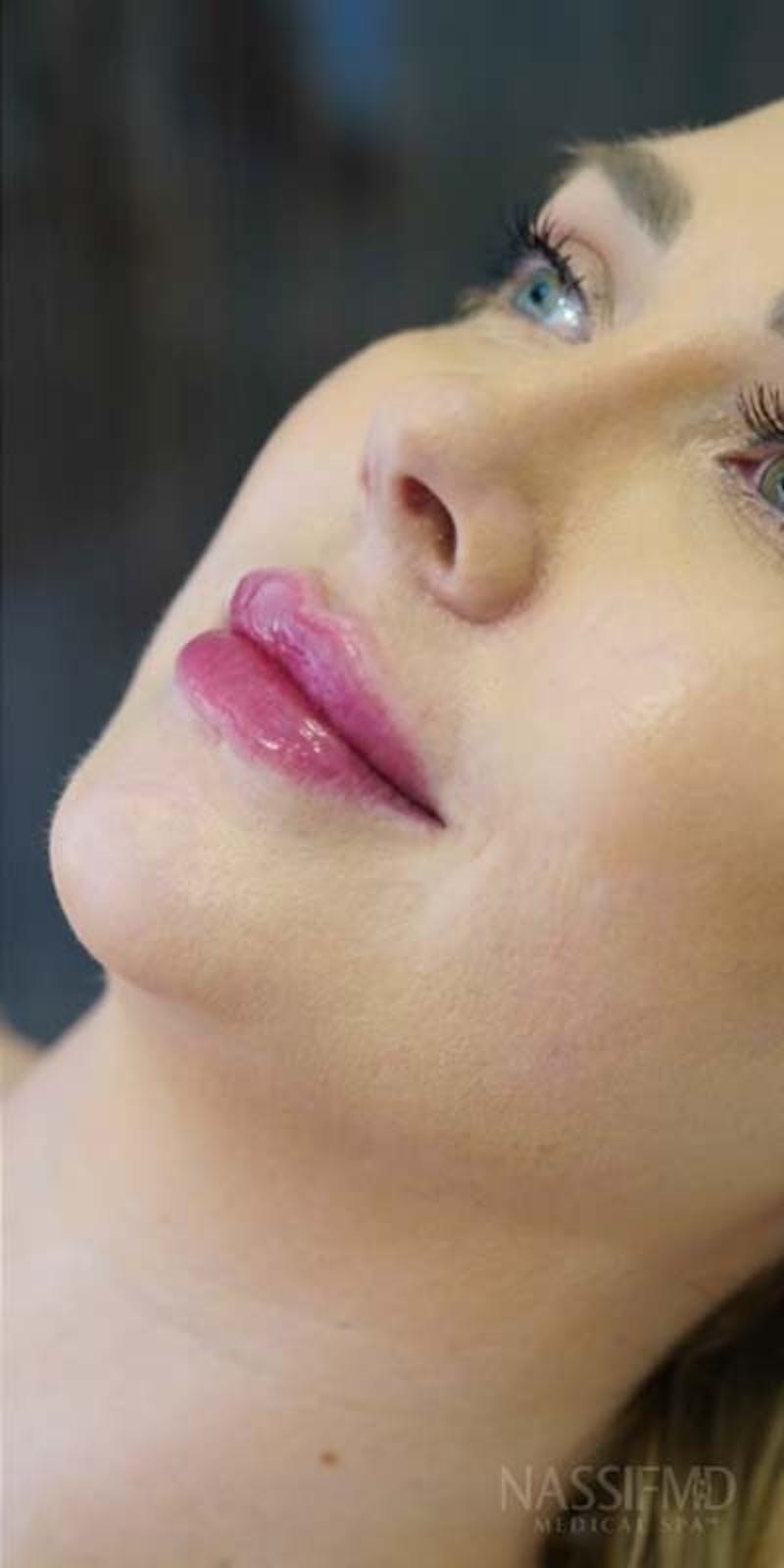 Fillers Before & After Gallery - Patient 121378856 - Image 2