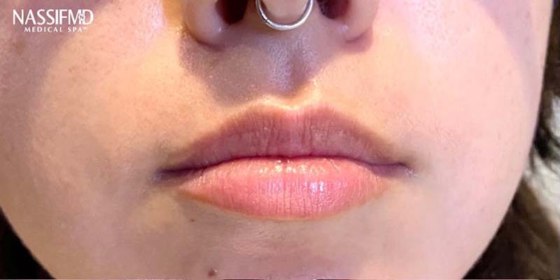 Fillers Before & After Gallery - Patient 121378855 - Image 1