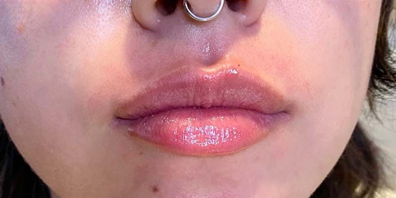 Fillers Before & After Gallery - Patient 121378855 - Image 2