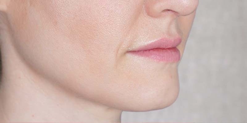 Fillers Before & After Gallery - Patient 121378857 - Image 1
