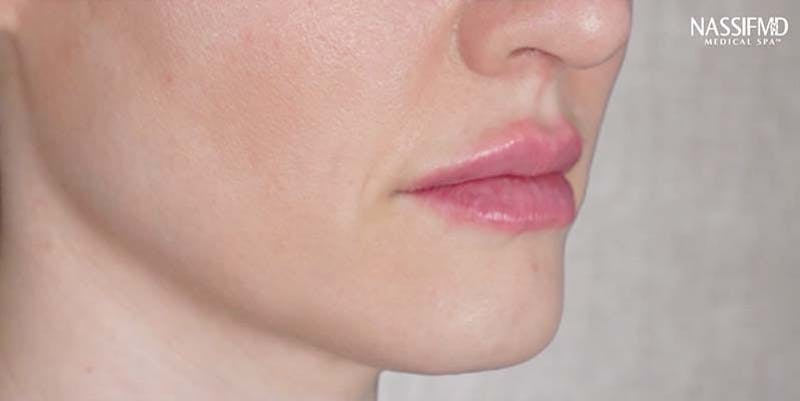 Fillers Before & After Gallery - Patient 121378857 - Image 2