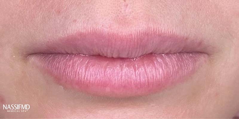 Fillers Before & After Gallery - Patient 121378858 - Image 1