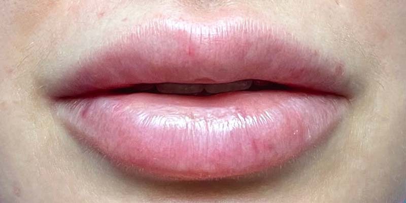 Fillers Before & After Gallery - Patient 121378858 - Image 2