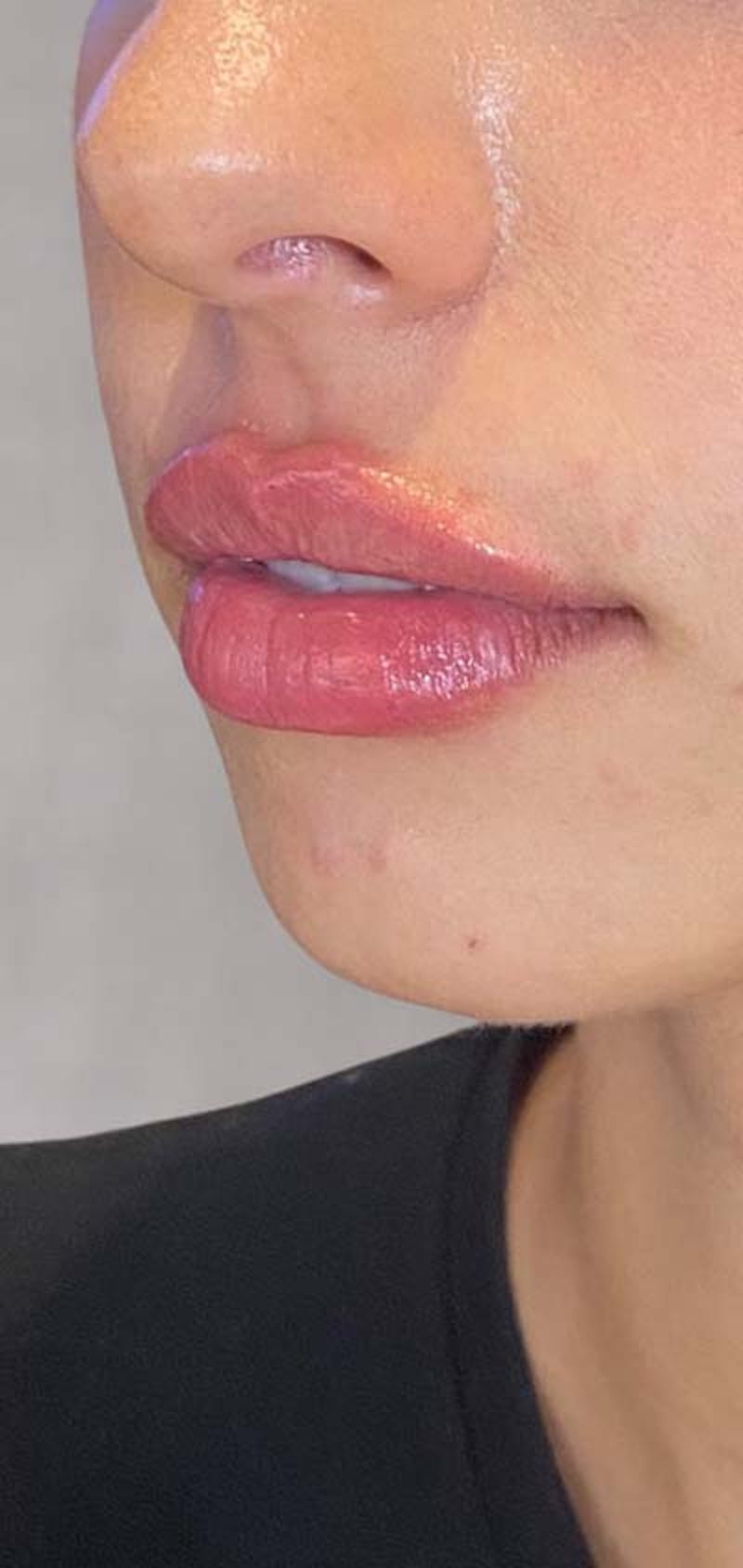 Fillers Before & After Gallery - Patient 121378860 - Image 2
