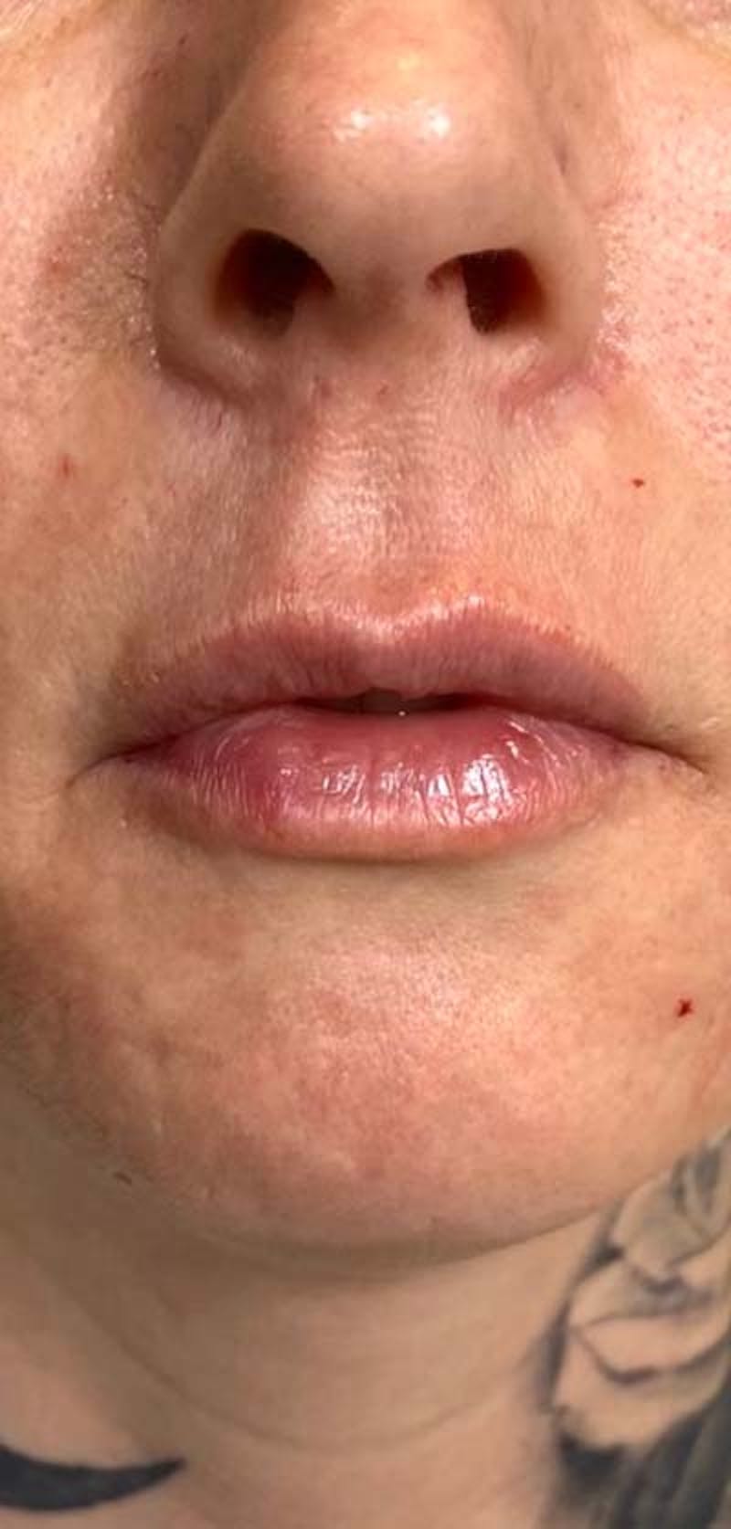 Fillers Before & After Gallery - Patient 121378861 - Image 2