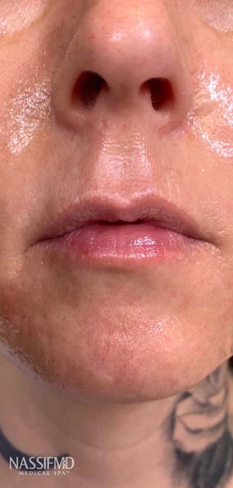Fillers Before & After Gallery - Patient 121378861 - Image 1
