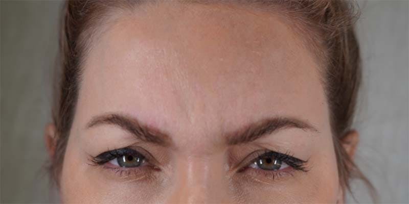 BOTOX Before & After Gallery - Patient 121400355 - Image 1
