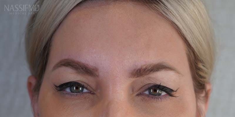 BOTOX Before & After Gallery - Patient 121400355 - Image 2