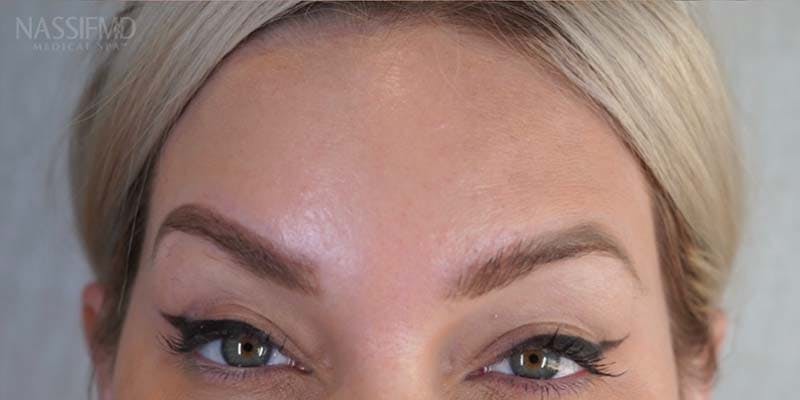 BOTOX Before & After Gallery - Patient 121400355 - Image 4