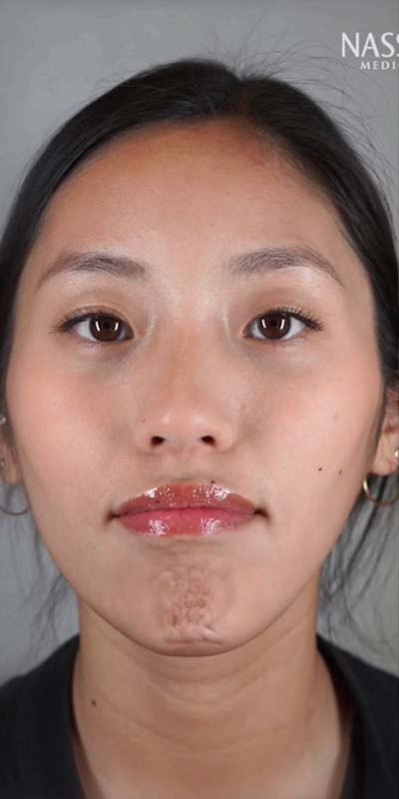 BOTOX Before & After Gallery - Patient 121400356 - Image 1