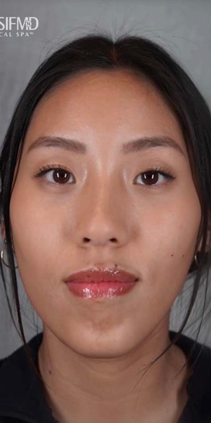 BOTOX Before & After Gallery - Patient 121400356 - Image 2