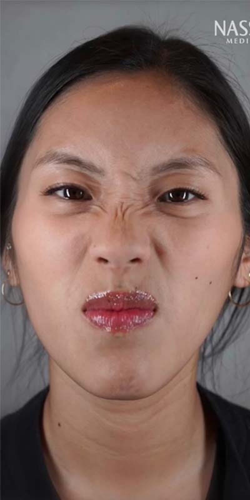 BOTOX Before & After Gallery - Patient 121400356 - Image 3