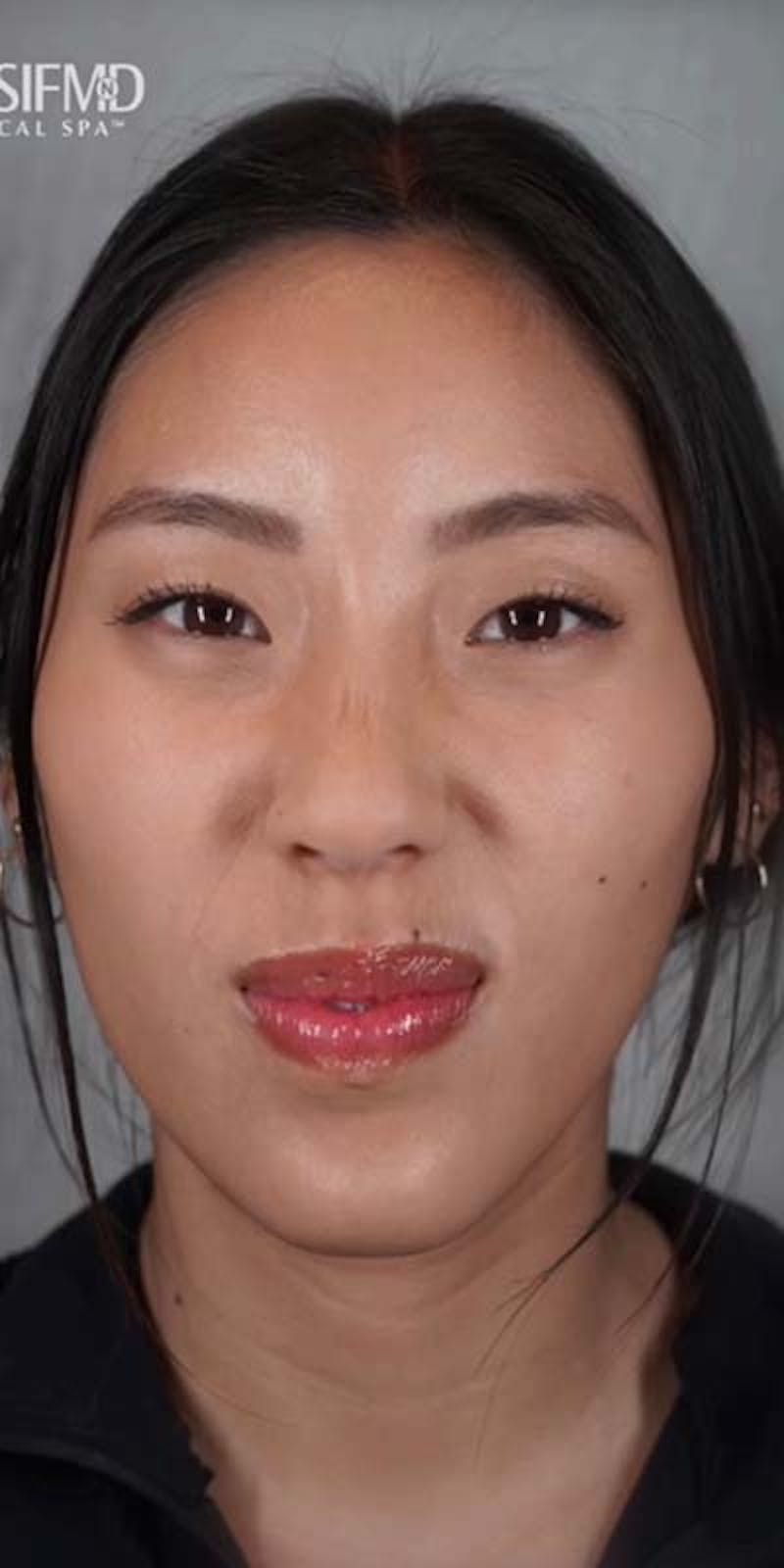 BOTOX Before & After Gallery - Patient 121400356 - Image 4