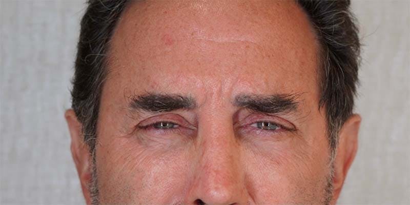 BOTOX Before & After Gallery - Patient 121400357 - Image 1