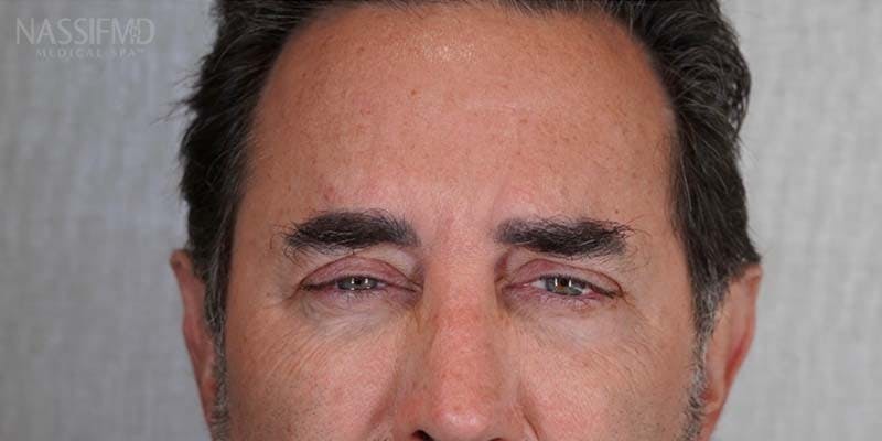 BOTOX Before & After Gallery - Patient 121400357 - Image 2