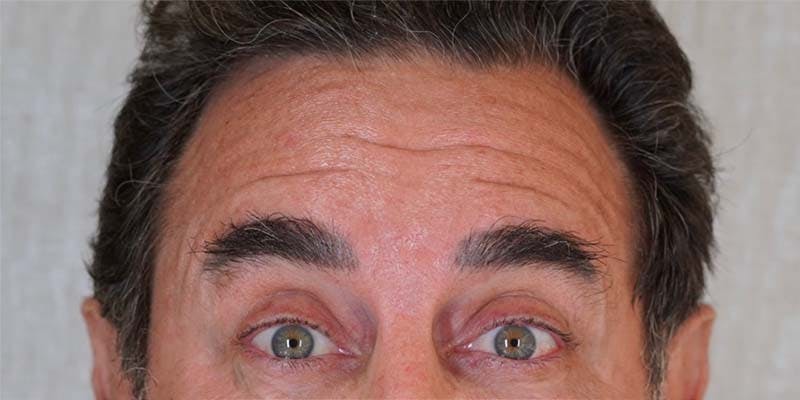 BOTOX Before & After Gallery - Patient 121400357 - Image 3