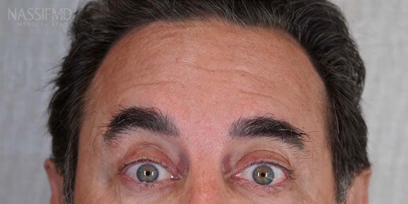 BOTOX Before & After Gallery - Patient 121400357 - Image 4