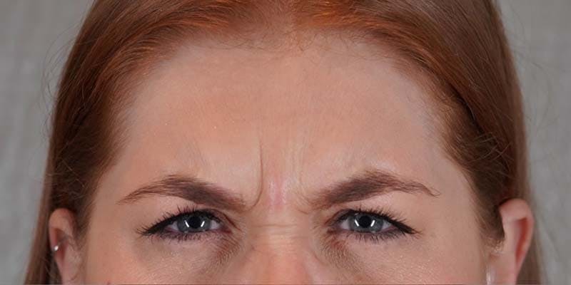 BOTOX Before & After Gallery - Patient 121400358 - Image 1