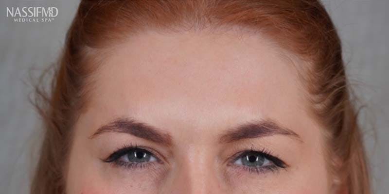 BOTOX Before & After Gallery - Patient 121400358 - Image 2