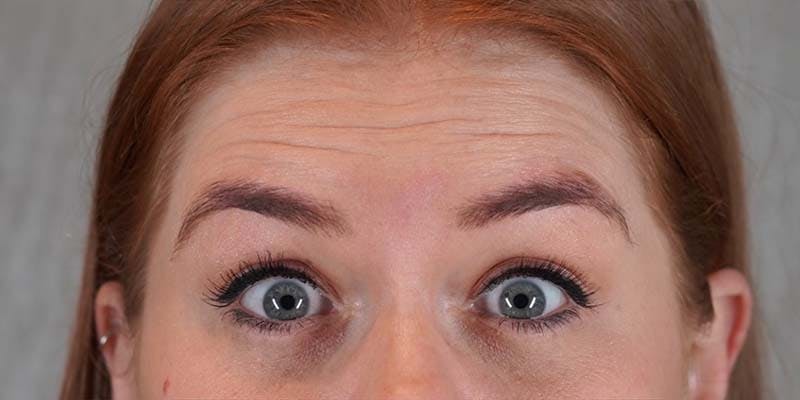 BOTOX Before & After Gallery - Patient 121400358 - Image 3
