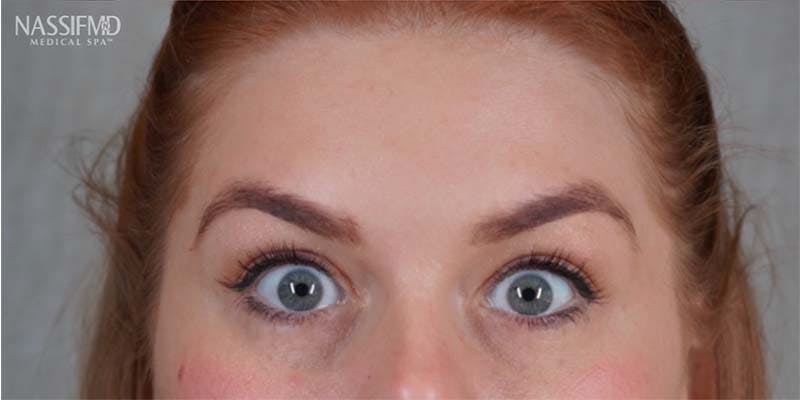 BOTOX Before & After Gallery - Patient 121400358 - Image 4