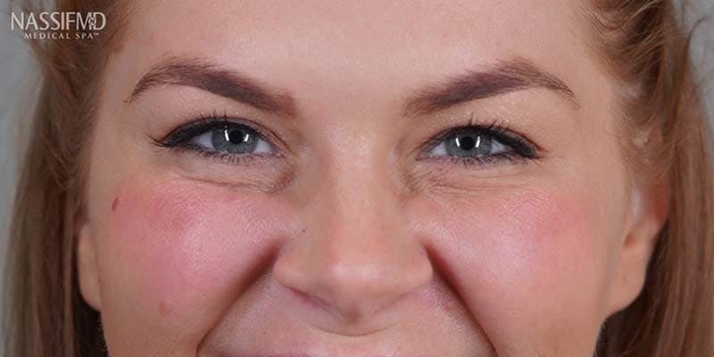 BOTOX Before & After Gallery - Patient 121400358 - Image 6