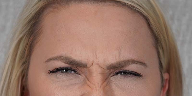 BOTOX Before & After Gallery - Patient 121400359 - Image 1