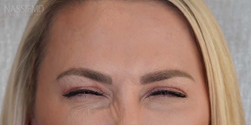BOTOX Before & After Gallery - Patient 121400359 - Image 2