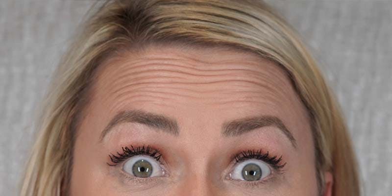 BOTOX Before & After Gallery - Patient 121400359 - Image 3