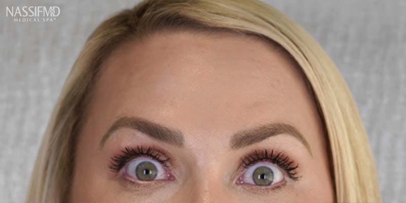 BOTOX Before & After Gallery - Patient 121400359 - Image 4