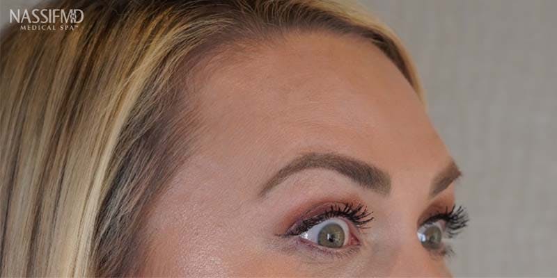 BOTOX Before & After Gallery - Patient 121400359 - Image 6