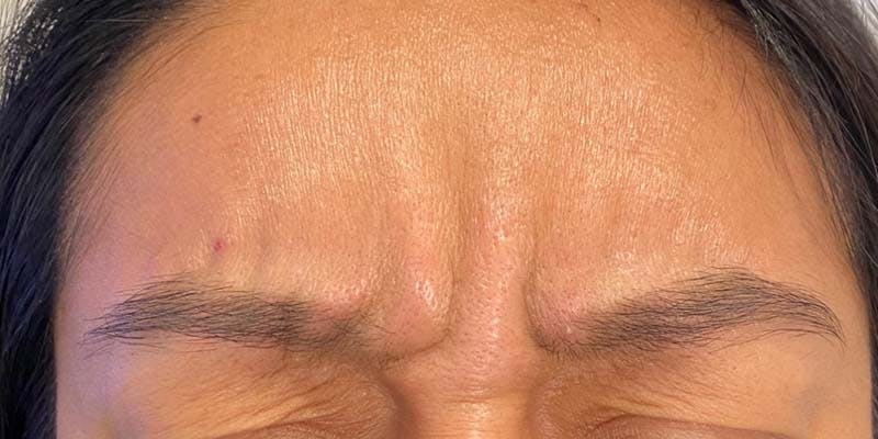 BOTOX Before & After Gallery - Patient 121400360 - Image 1