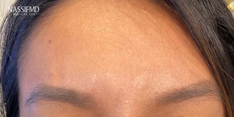 BOTOX Before & After Gallery - Patient 121400360 - Image 2