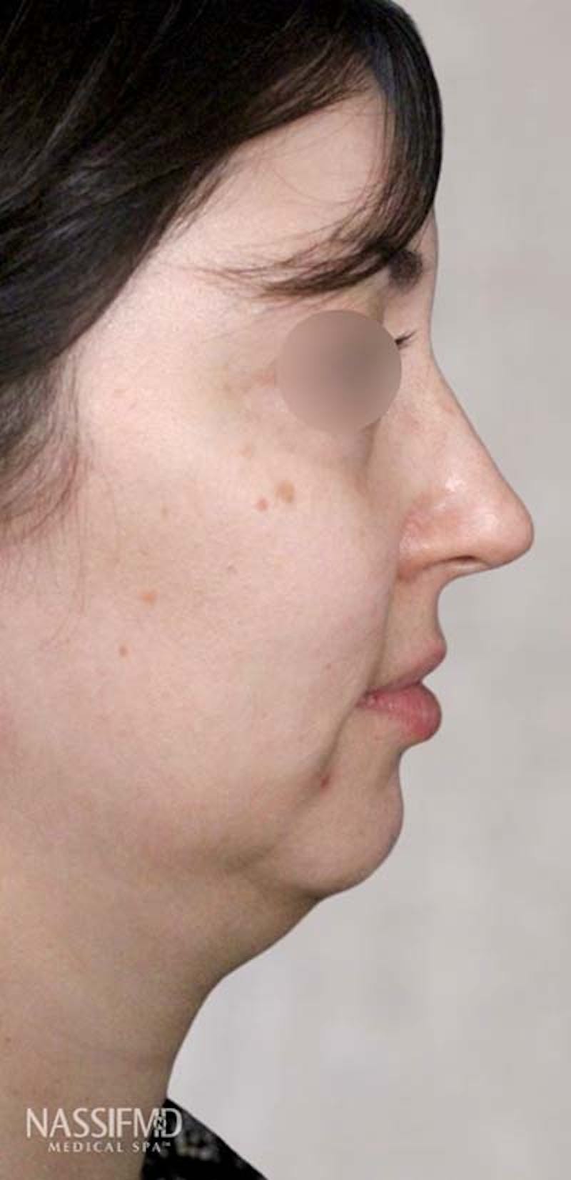 Kybella Before & After Gallery - Patient 121400390 - Image 1