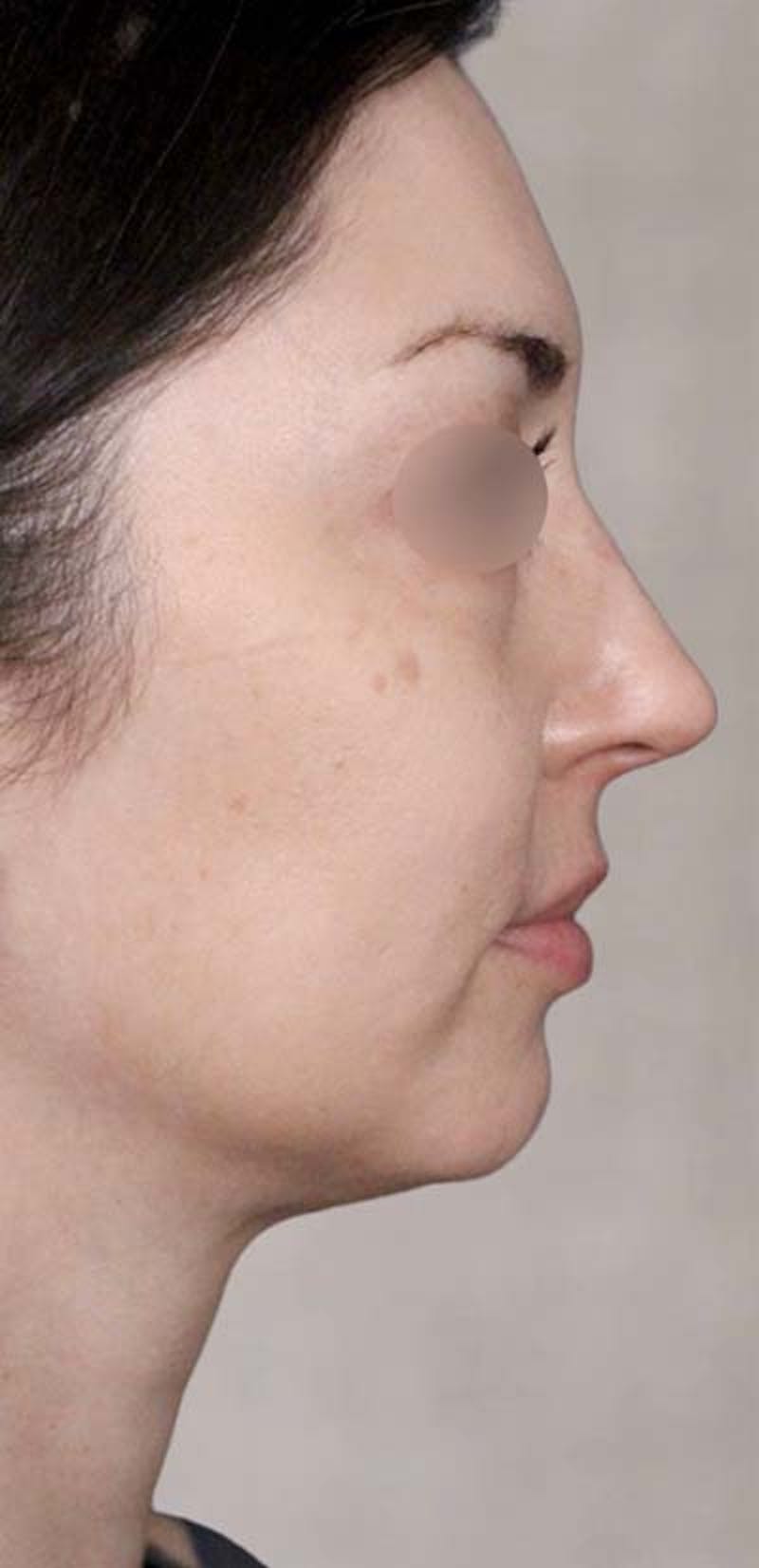 Kybella Before & After Gallery - Patient 121400390 - Image 2